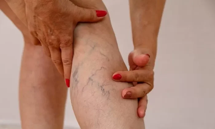 Tem Varizes? Saiba Quais Exercícios Melhoram a Circulação e os Cuidados Necessários