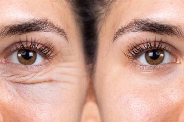 Blefaroplastia: cirurgia para rejuvenescimento do olhar com segurança