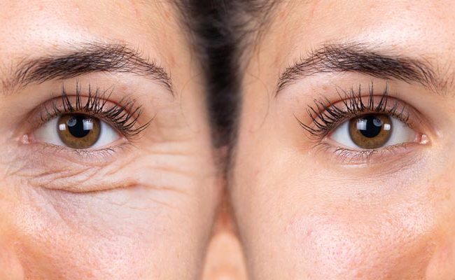 Blefaroplastia: cirurgia para rejuvenescimento do olhar com segurança
